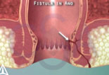 Fistula