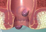 Hemorrhoids - 3D Medical Animation