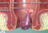 Rubber Band ligation for hemorrhoids