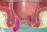 Thrombosed External Hemorrhoid