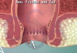 Anal Fissure 3D