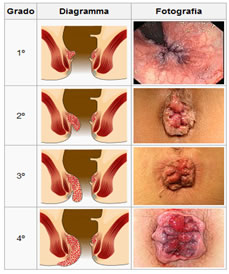 emorroidi-classificazione